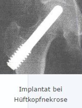 implantat1a
